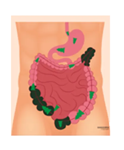 Virechana (Therapeutic Purgation)